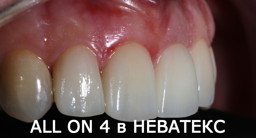 Ровные белые зубы за один день зубы за один день